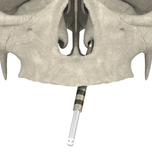 JDNasal TranZ Drill
